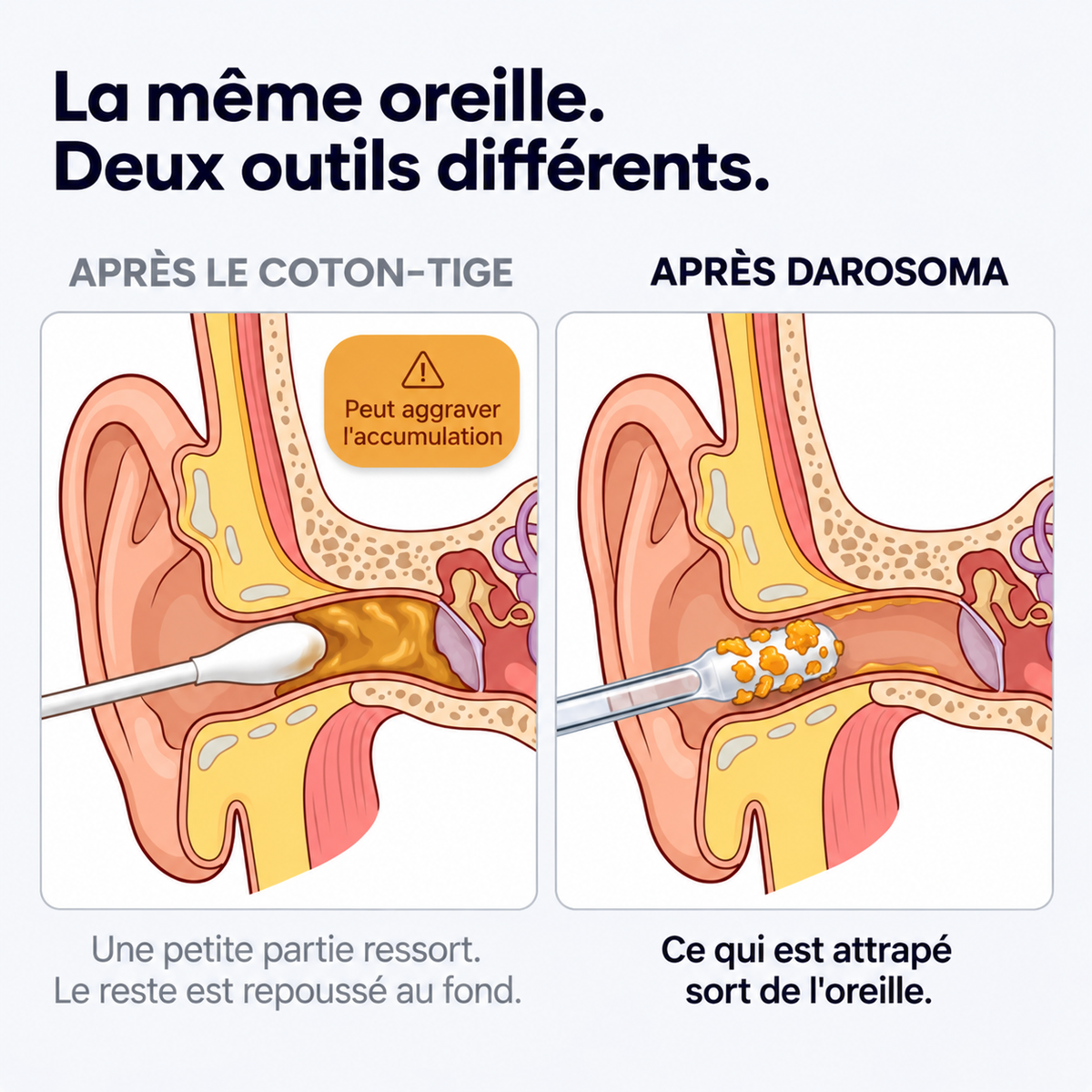 Darosoma® Nettoyeur d'oreille adhésif