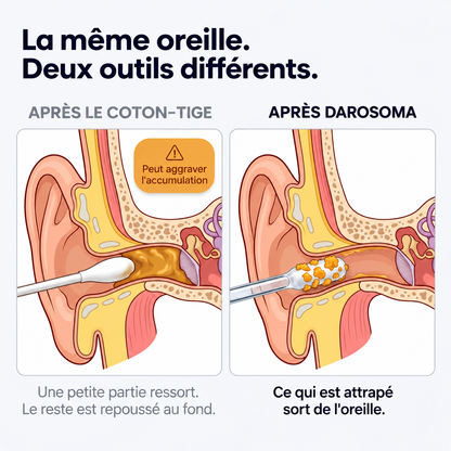 Darosoma® Nettoyeur d'oreille adhésif